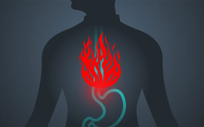 Tractaments naturals i eficaços en l’abordatge del Reflux Gastroesofàgic (ERGE)